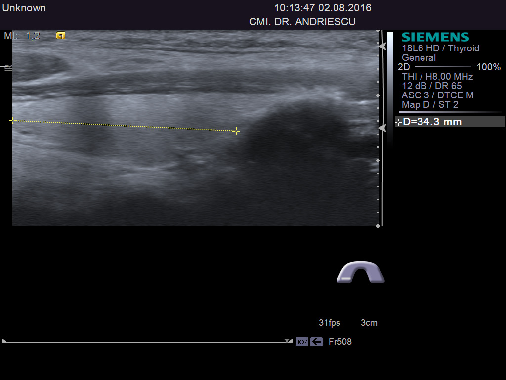 Tiroida-scanare in plan longitudinal