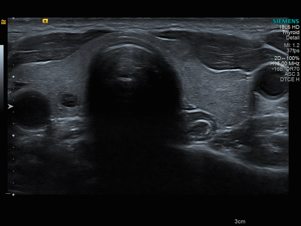 Tiroida-scanare in plan transversal